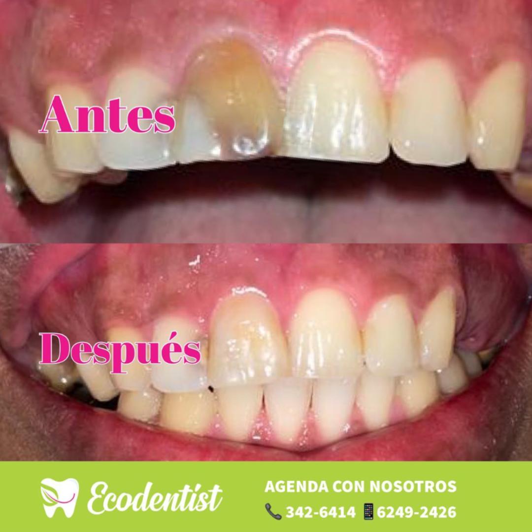 Blanqueamiento dental en una sola piesa - Blanqueamiento dental interno - Ecoclinic Panamá