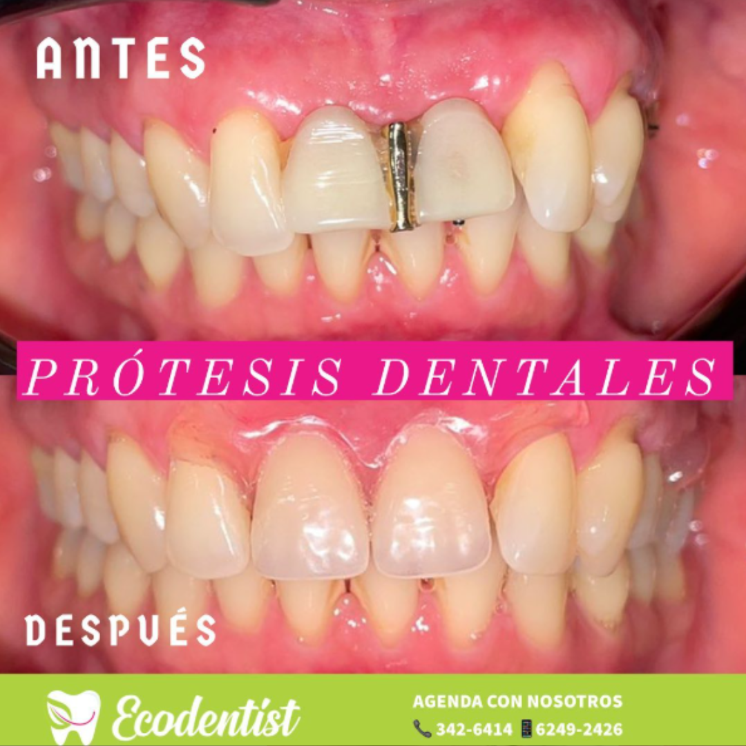 Prótesis Dental Permanente - Clinica Dental EcoDentist - Burunga Arraiján