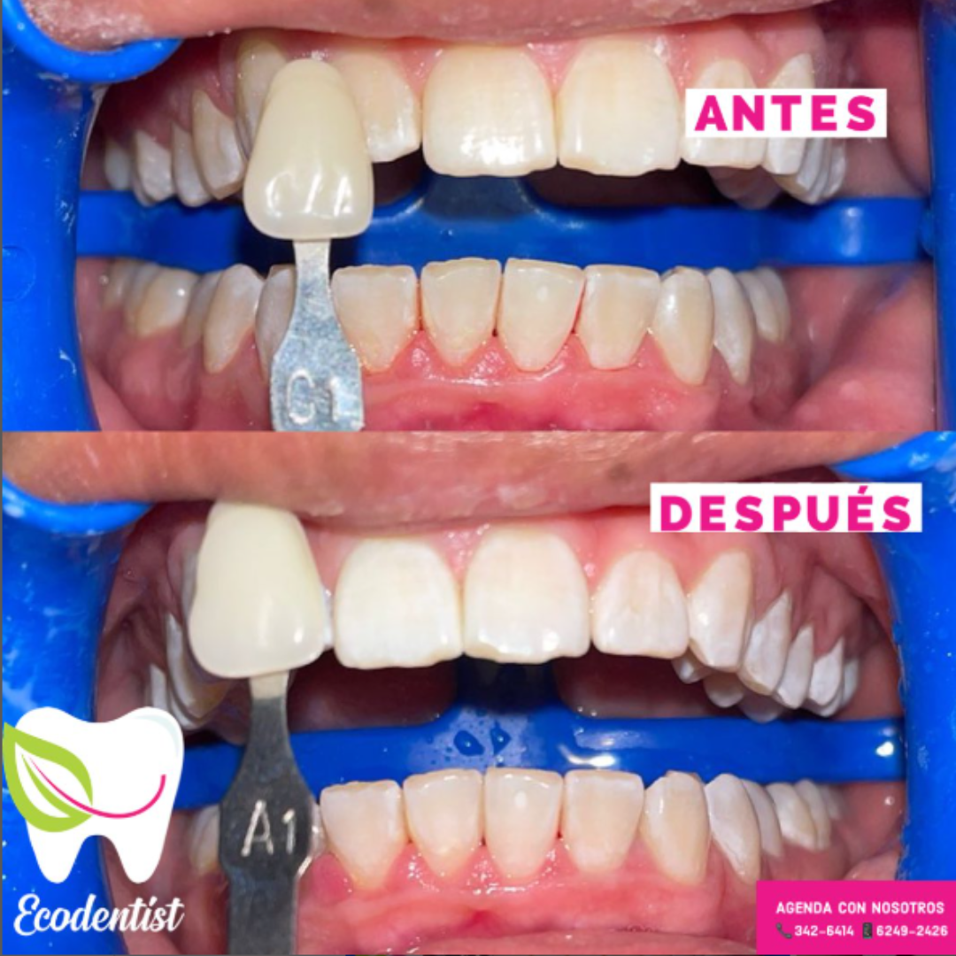 Resultado de Blanqueamiento dental 1 - Clinica Dental EcoDentist - Burunga Arraiján