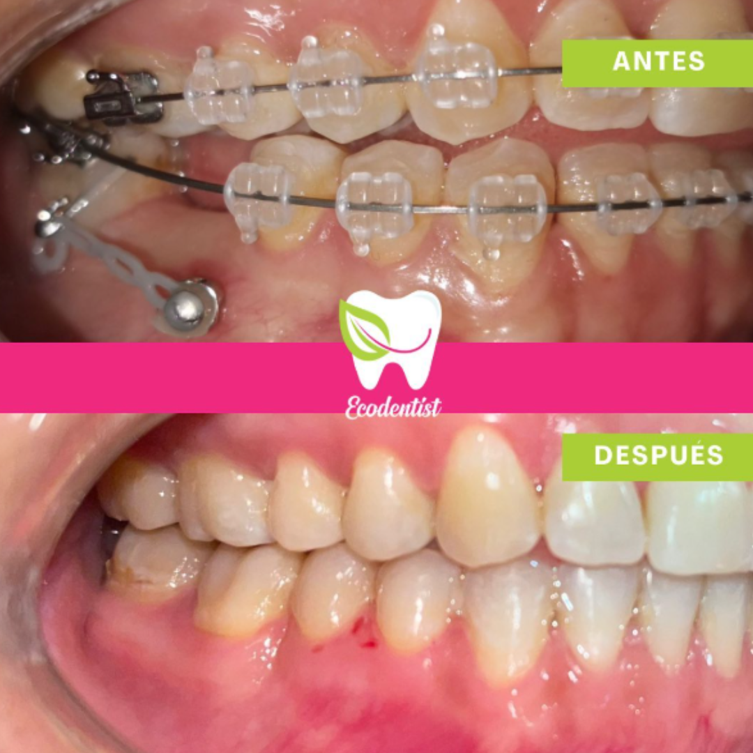 Resultado de Ortodoncia 3 - Clinica Dental EcoDentist - Burunga Arraiján