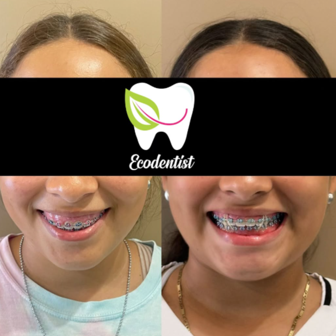 Resultado de Ortodoncia 4 - Clinica Dental EcoDentist - Burunga Arraiján