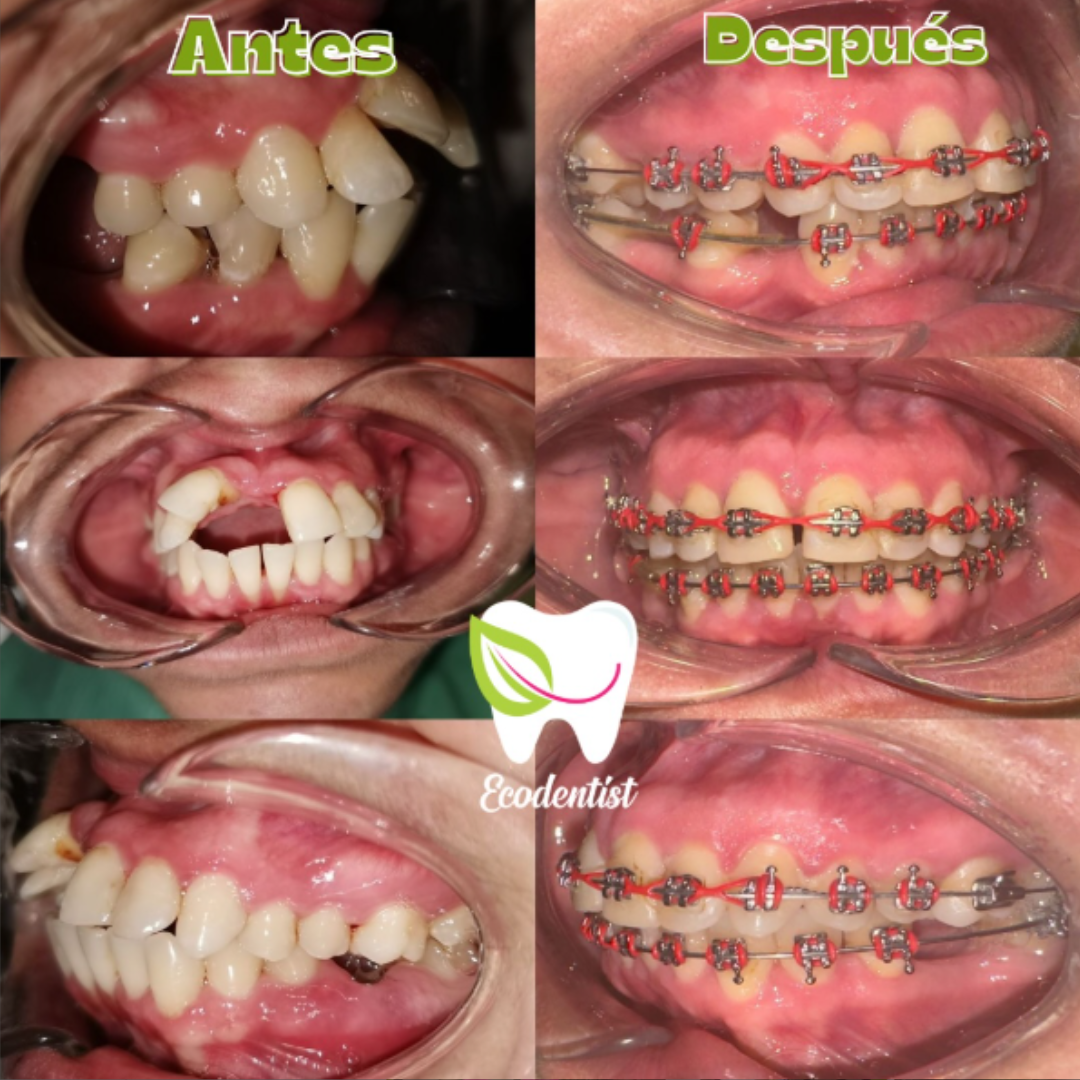 Resultado de Ortodoncia1 - Clinica Dental EcoDentist - Burunga Arraiján