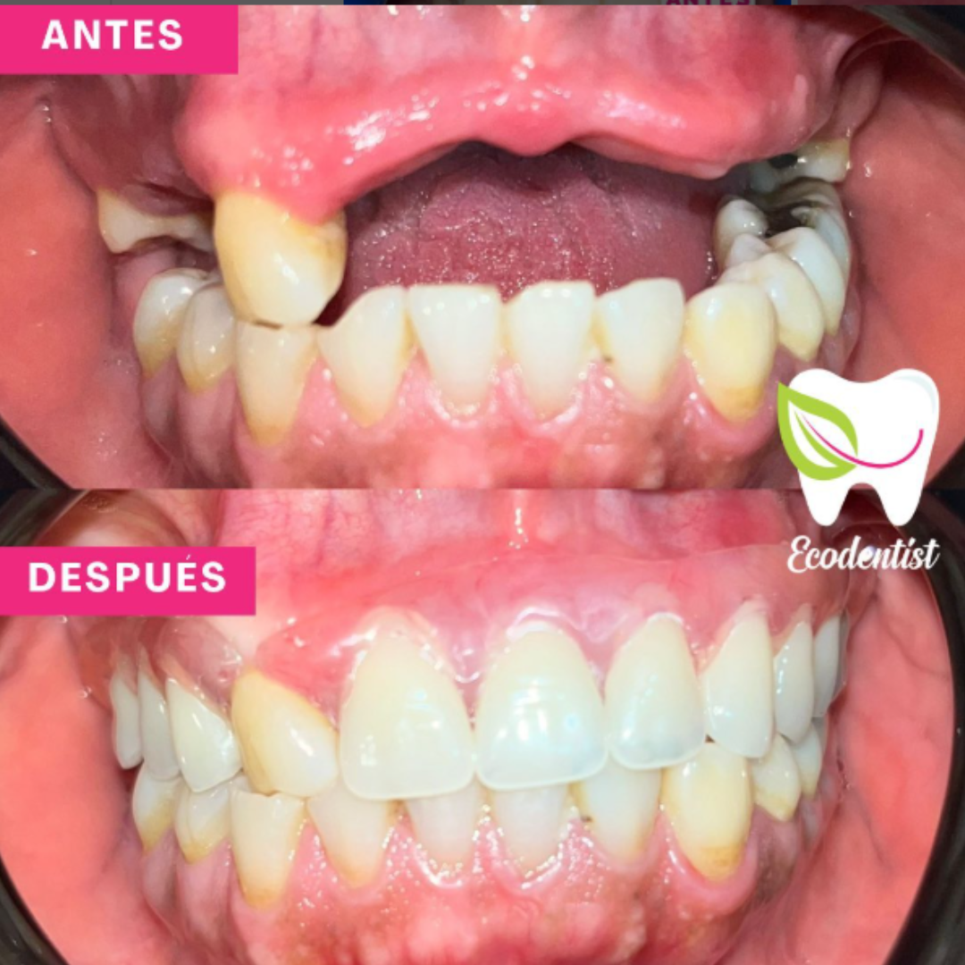 Resultado de Prótesis dental removible 1 - Clinica Dental EcoDentist - Burunga Arraiján