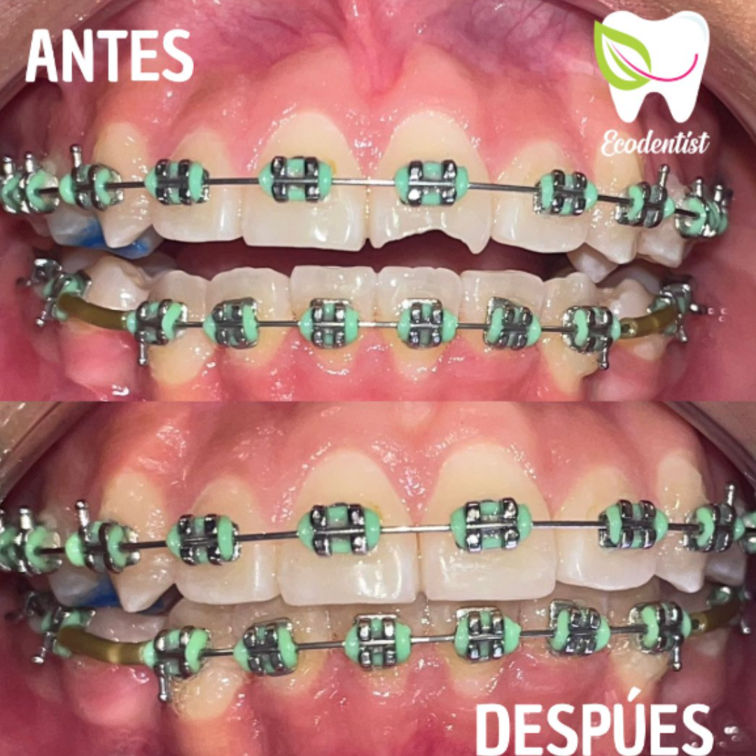 Resultado de Reconstrucción Dental 1 - Clinica Dental EcoDentist - Burunga Arraiján