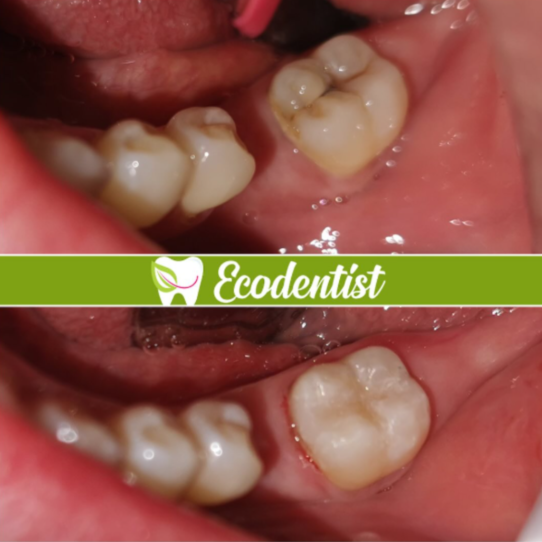 Resultado de Reconstrucción Dental 2 - Clinica Dental EcoDentist - Burunga Arraiján