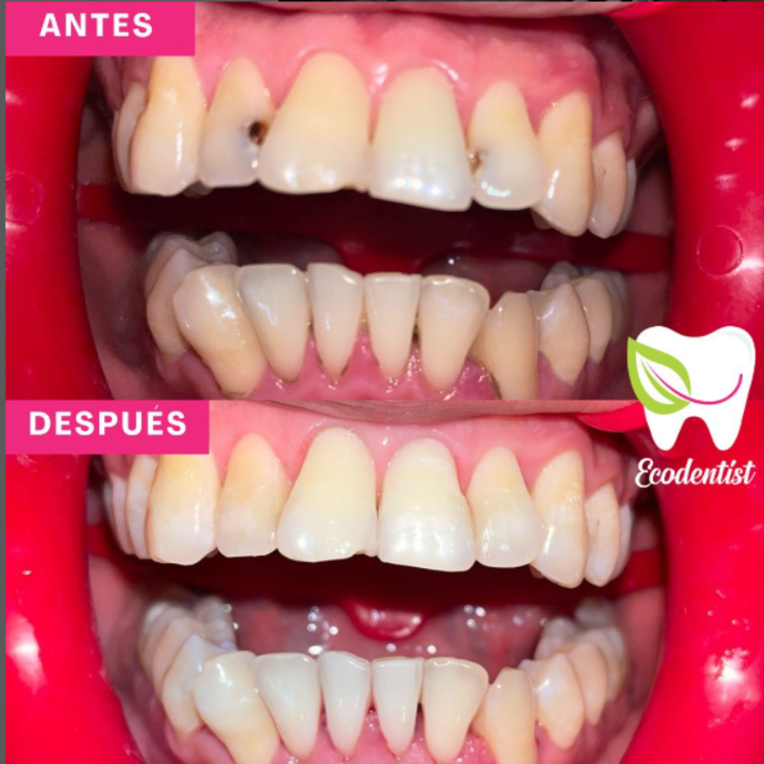 Resultado de Reconstrucción Dental 3 - Clinica Dental EcoDentist - Burunga Arraiján