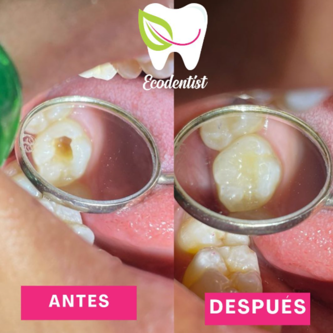 Resultado de Reconstrucción Dental 4 - Clinica Dental EcoDentist - Burunga Arraiján