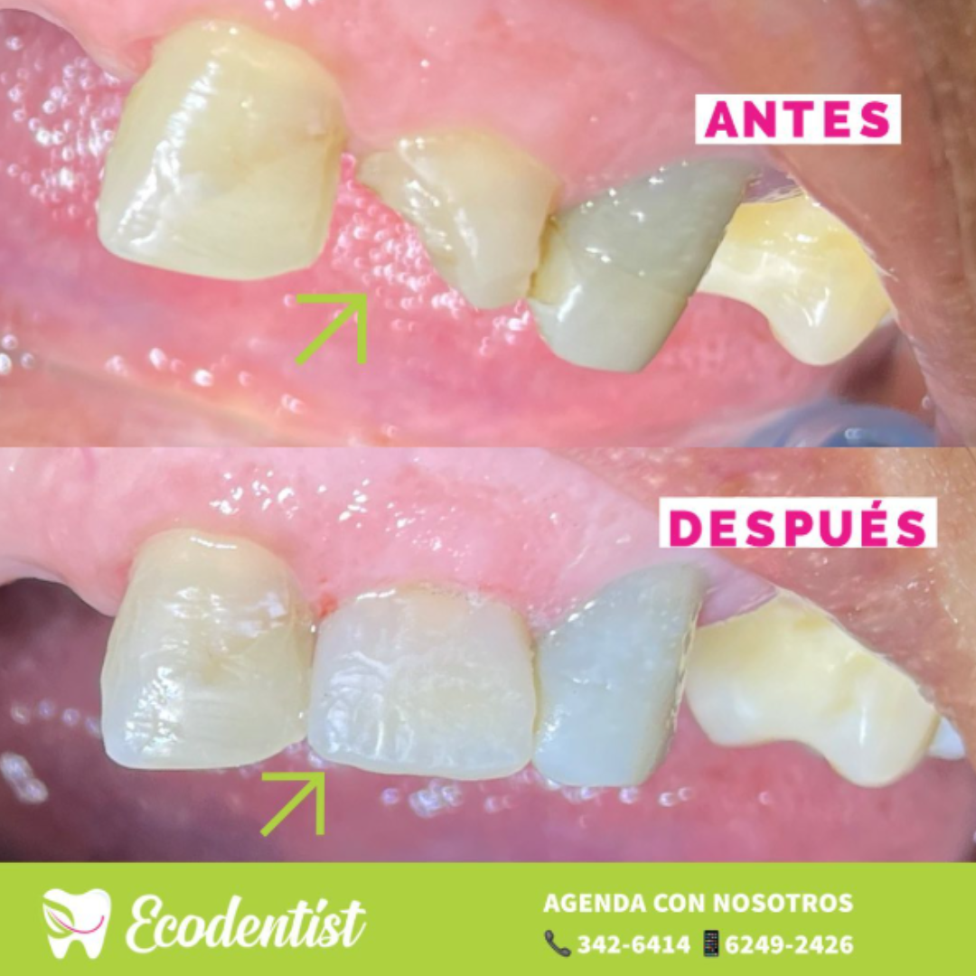 Resultado de Reconstrucción Dental 6 - Clinica Dental EcoDentist - Burunga Arraiján