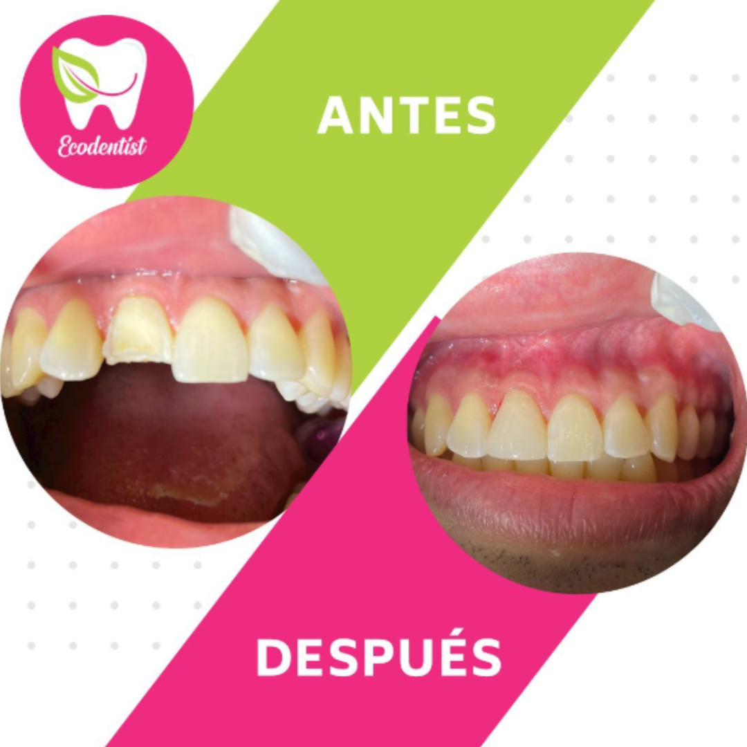 Resultado de Reconstrucción Dental 7- Clinica Dental EcoDentist - Burunga Arraiján