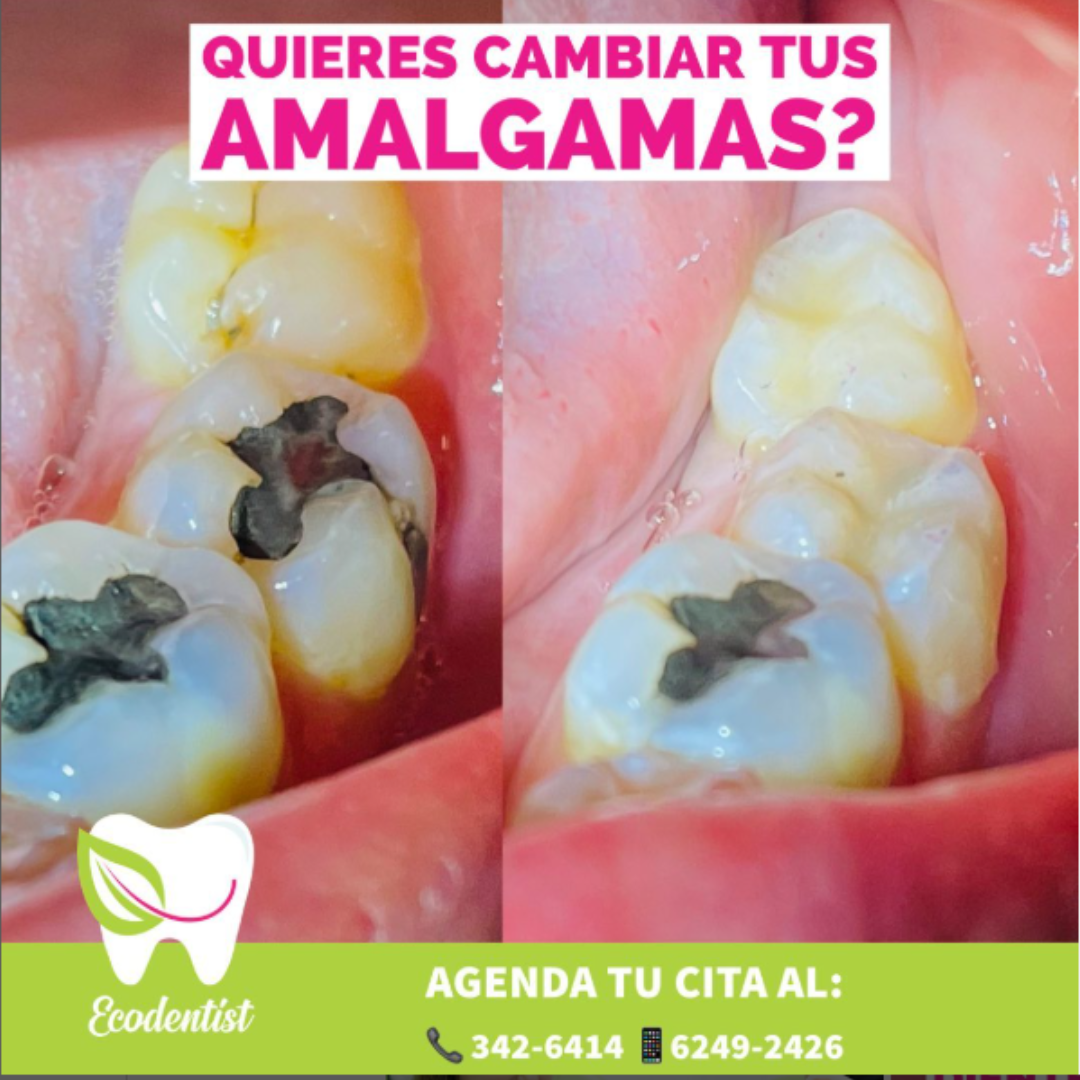 Resultado de Reconstrucción Dental 8 - Clinica Dental EcoDentist - Burunga Arraiján